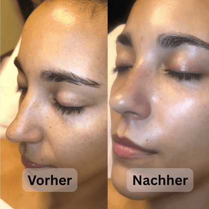 Reis Peeling
