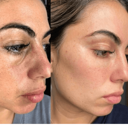 Reis Peeling