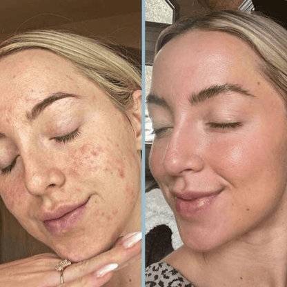 Reis Peeling