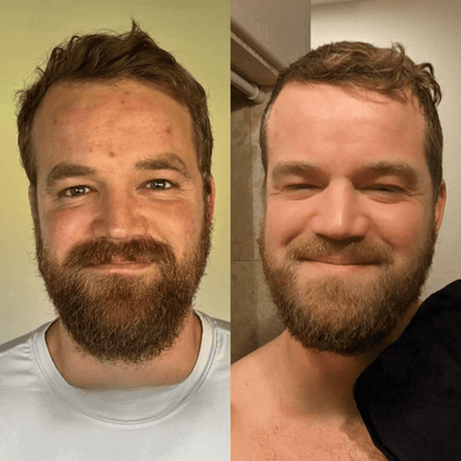 Reis Peeling